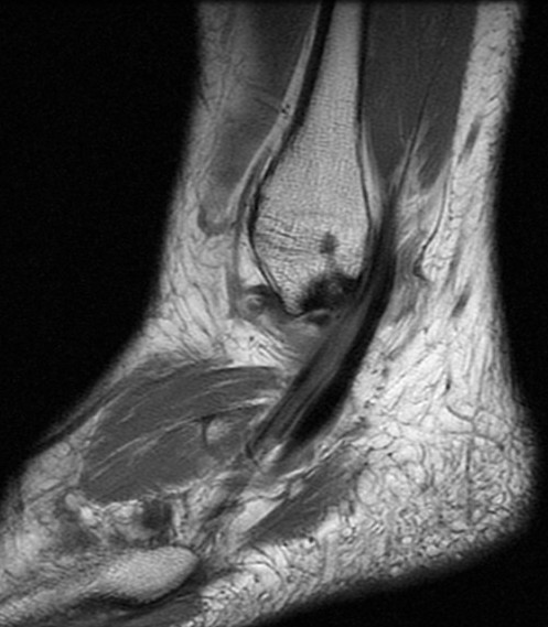 Figure 3 for case Peroneus brevis split tear